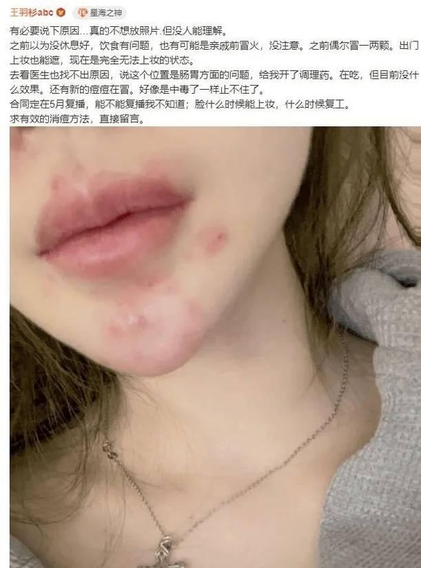 王羽杉事件后续复播在即，皮肤“冒火”状况令人堪忧！